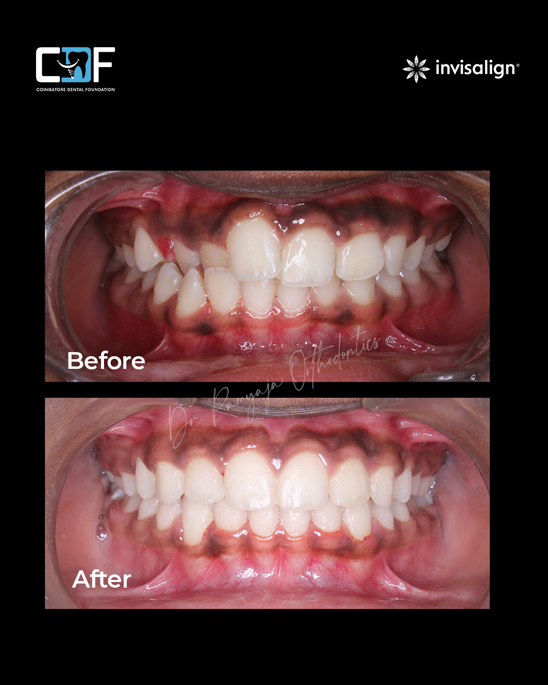 Before After Result
